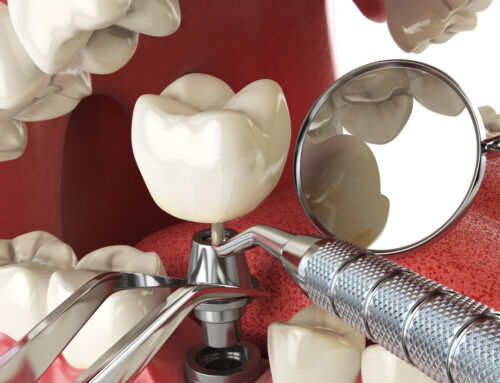 İmplant Diş Tedavisi